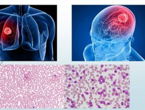Рак - одно из наиболее опасных заболеваний человечества